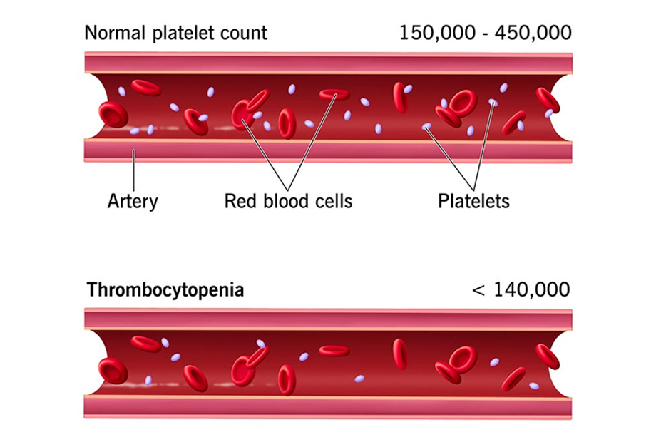 Low Platelets and Type 1 Diabetes