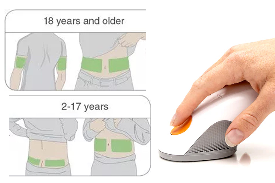 Placement Sites of Dexcom G6 Sensor