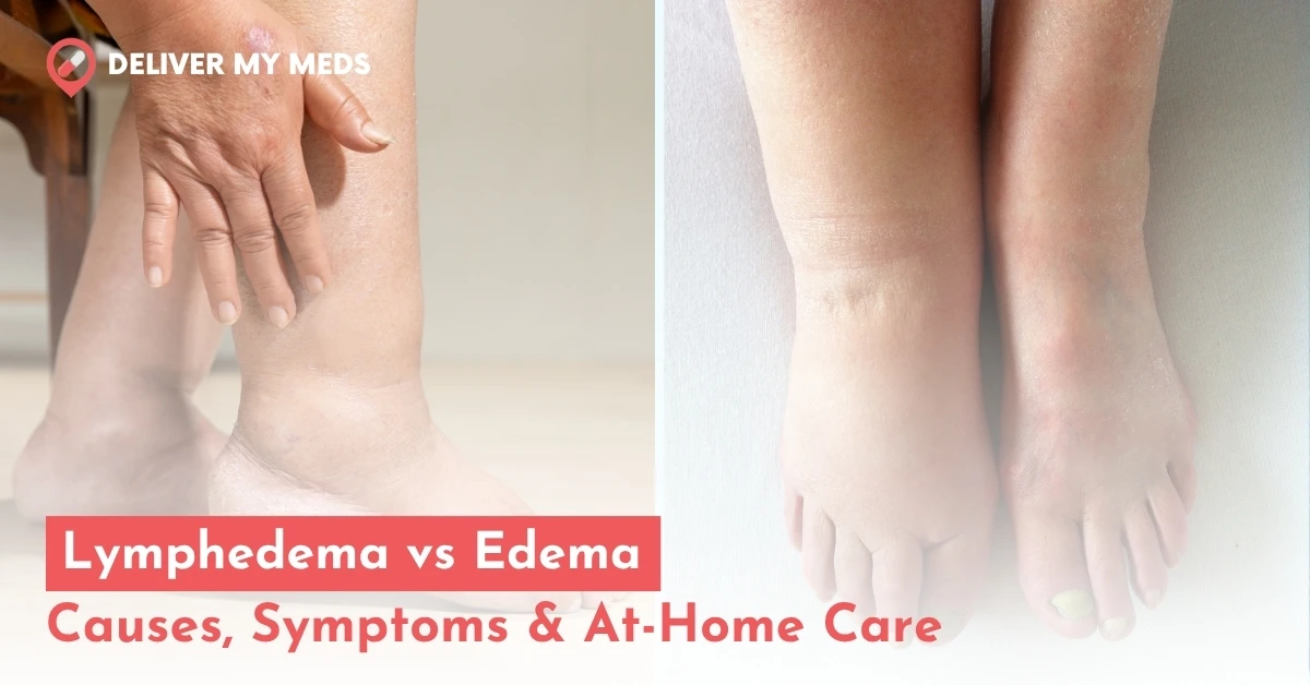 Lymphedema vs Edema